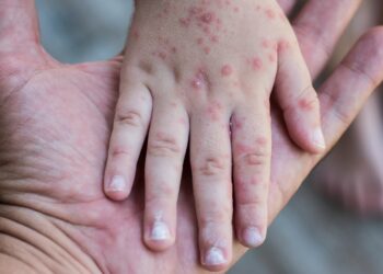 دليل فيروس جدري القردة من وزارة الصحة