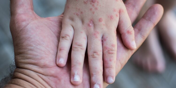 دليل فيروس جدري القردة من وزارة الصحة